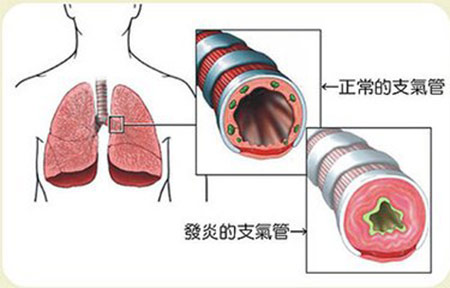 支气管炎 支气管炎
