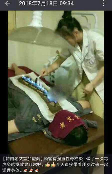 龙虎灸调理强直性脊柱炎
